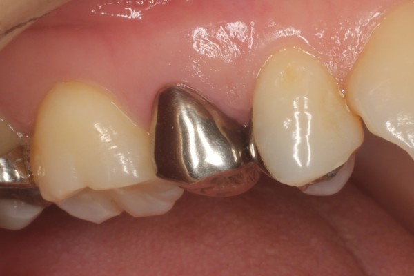 ３０代女性「奥歯の銀歯が目立つ」奥歯の銀歯をセラミックで白く治療 ...